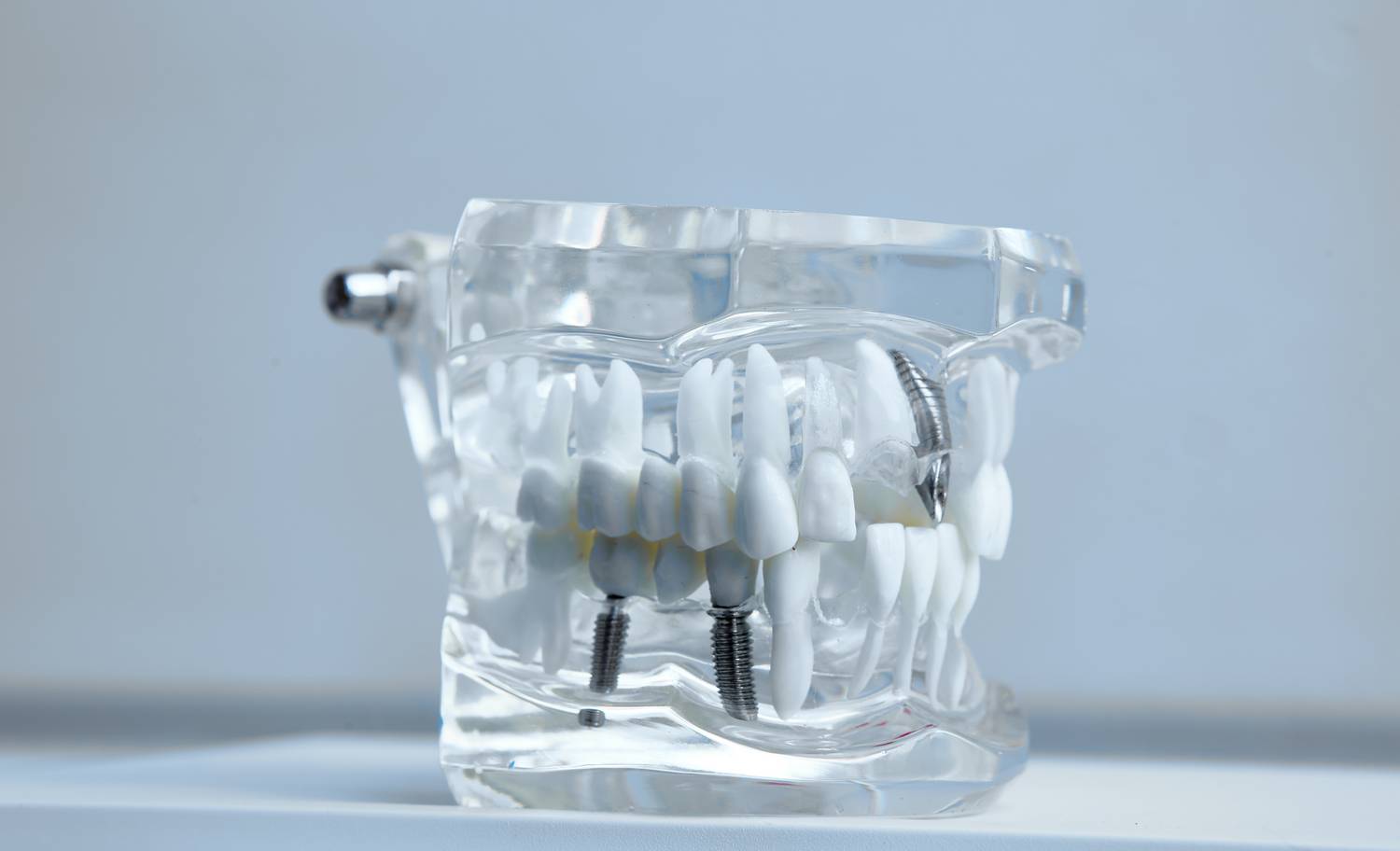 Implanty dentystyczne – czy mogą zastąpić prawdziwe zęby?